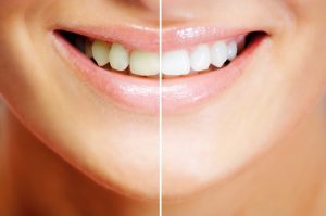 Teeth Whitening in Alpharetta