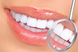 Teeth Whitening in Alpharetta