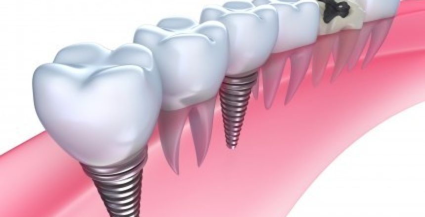 dental implants faqs