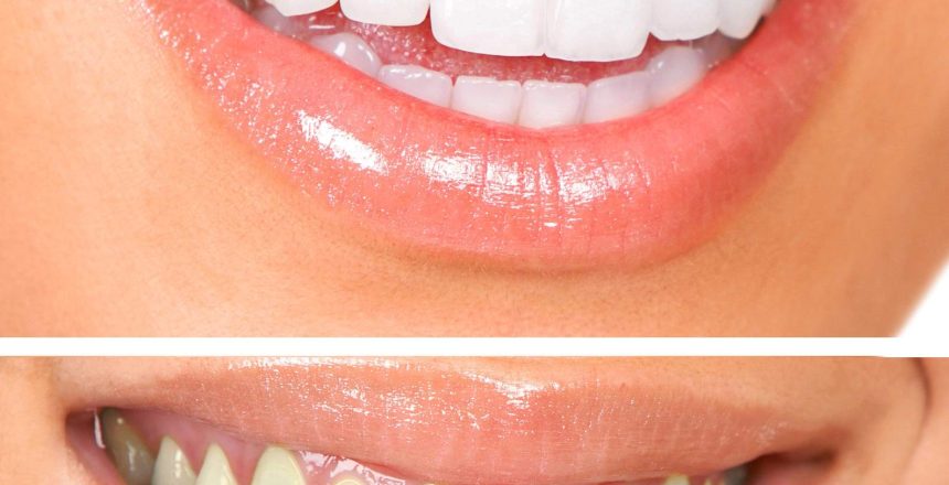 teeth whitening Alpharetta